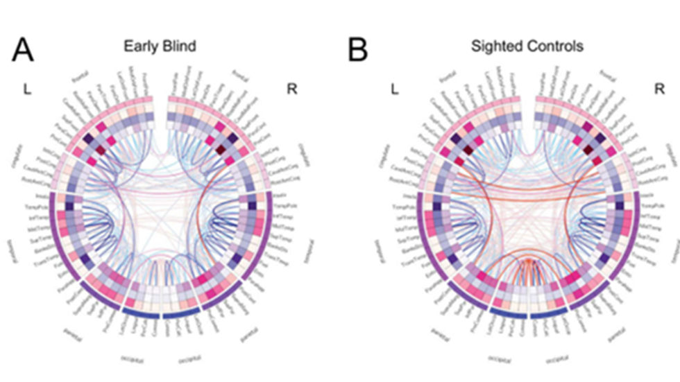 CIRCOS visualizations showing differences in structural and functional connectivity in blind and sighted individuals