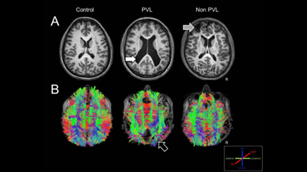 Structural MRI and white matter tractography of a control individual, an individual with CVI born prematurely and another CVI born at term