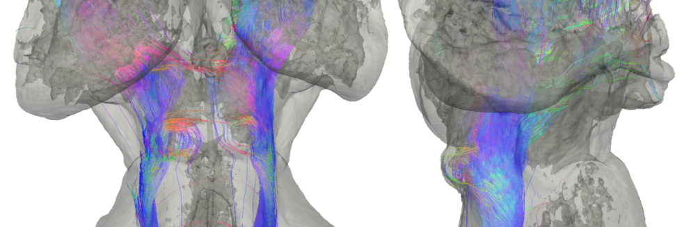 Diffusion MRI tractography of the subcortical auditory pathway in a postmortem human brain